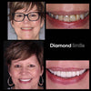 Donna anziana con sbiancamento dei denti prima e dopo le foto - Sbiancamento denti Diamond Smile