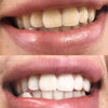 Esperienza di sbiancamento dentale Diamond Smile - Bocca con foto prima e dopo dei denti bianchi