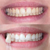 Esperienza di sbiancamento dentale Diamond Smile - Donna con foto prima e dopo dei denti bianchi