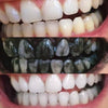 Esperienza di Diamond Smile sbiancamento dentale con polvere di carbone attivo - bocca con foto prima e dopo di denti bianchi